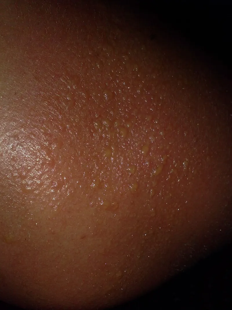 The Sunburn Paradox: Why Staying Out of the Sun Can Make You More Vulnerable to It
